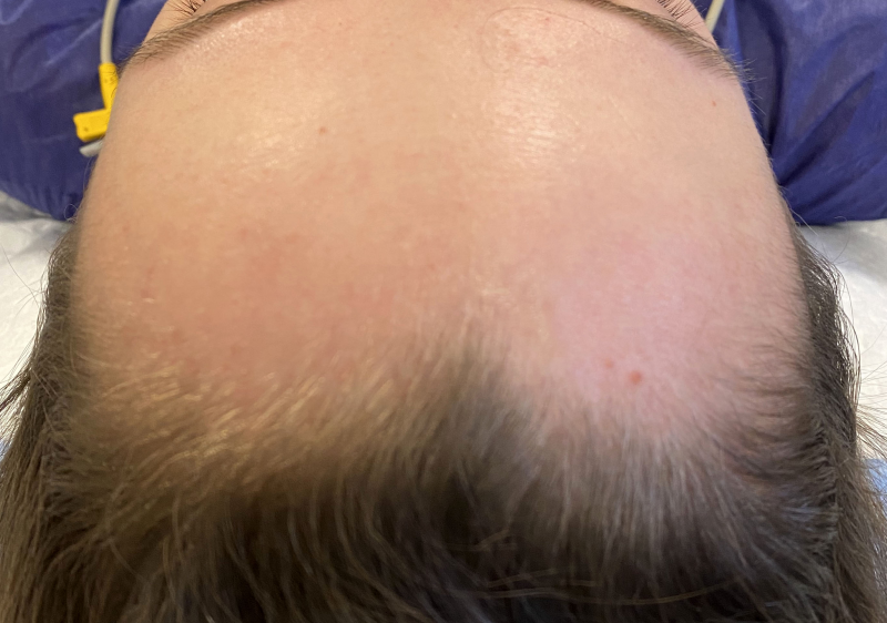 Abaissement De La Ligne Capillaire Lowering Hairline Or Advancement